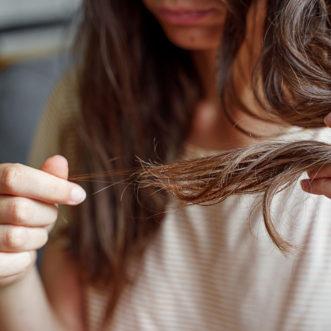 Hormonell bedingter Haarausfall