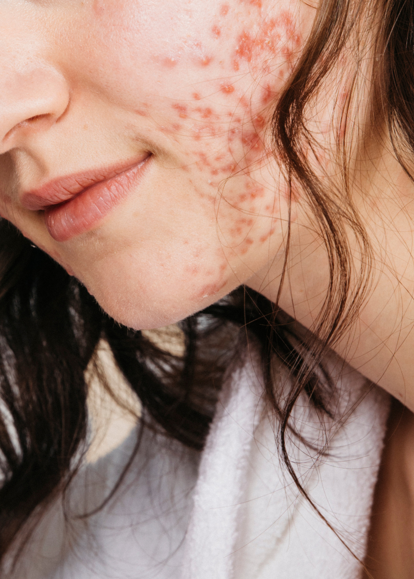 Ausschnitt Gesicht weiblich gelesener Person mit hormoneller Akne