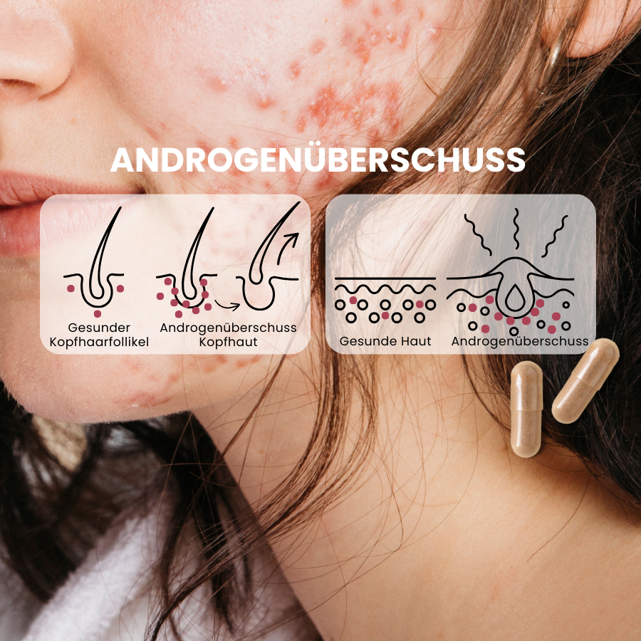 graphische Darstellung der Wirkung von Androgenüberschuss  auf Haarfollikel und Talgdrüsen, fenou Nahrungsergänzung