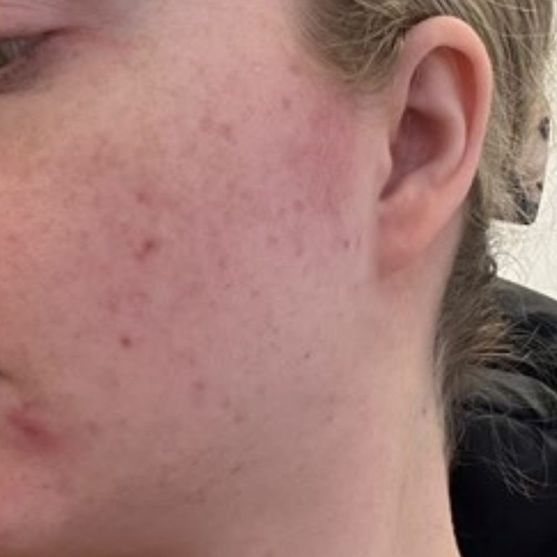 Wange mit hormoneller Akne nach Verzehr von fenou beauty
