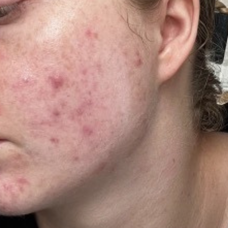 Wange mit hormoneller Akne vor Verzehr von fenou beauty