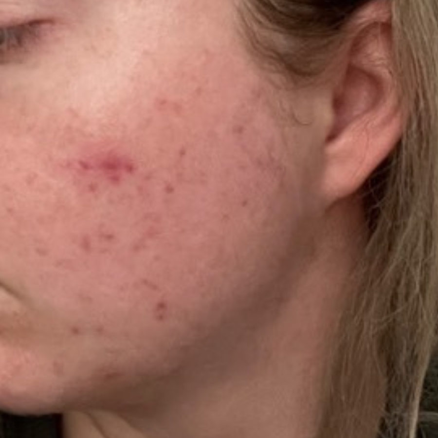 Wange mit hormoneller Akne während Verzehr von fenou beauty